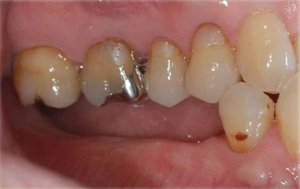下顎インプラント奥歯3本治療前