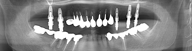 インプラント埋入治療が完了レントゲン