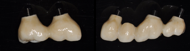 治療後セラミッククラウン