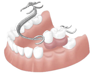 部分入れ歯