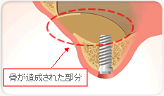 サイナスリフト