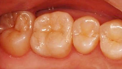 ハイブリッドインレー奥歯1本治療後