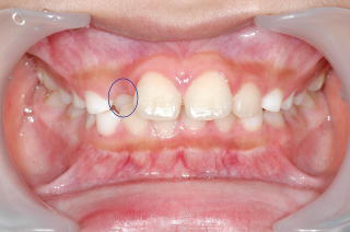 前2番の歯の凹み治療前