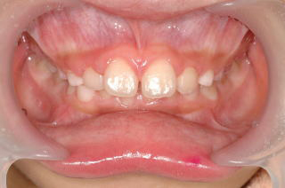 前2番の歯の凹み治療後