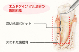 歯周再生療法エムドゲイン治療前