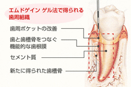 歯周再生療法エムドゲイン治療後