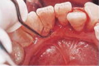 歯石除去のスケーリング中