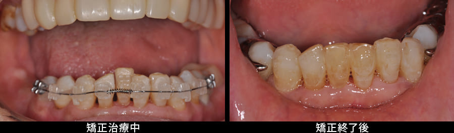 下顎前歯部のワイヤー矯正
